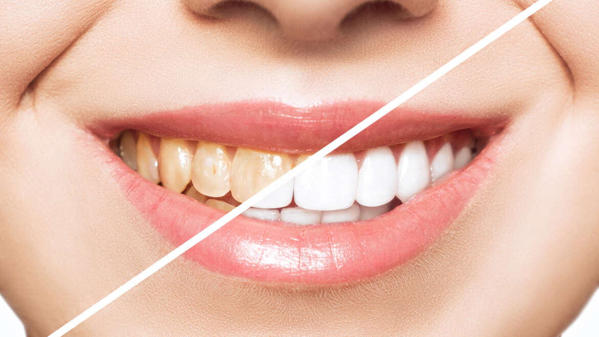 Veneers