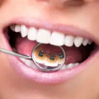 Braces Gallery Image